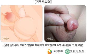 귀두포피염 이미지