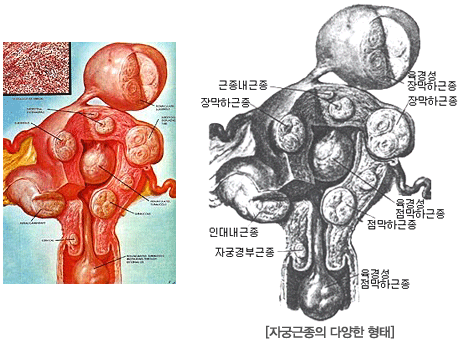 자궁근종의 다양한 형태 이미지