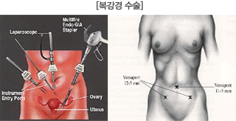 복강경 수술 이미지