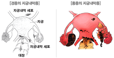 경증의 자궁내막증, 중증의 자궁내막증 이미지